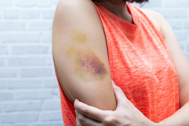 Bruise on woman arm. Injection bruises. Doctor and patient.