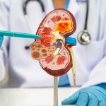 Kidney disease, Chronic kidney disease ckd, Doctor hold human model.