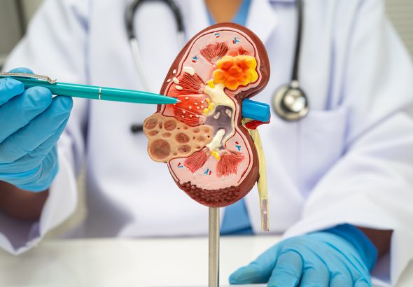 Kidney disease, Chronic kidney disease ckd, Doctor hold human model.