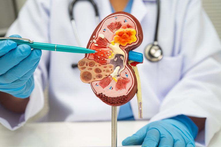 Kidney disease, Chronic kidney disease ckd, Doctor hold human model.